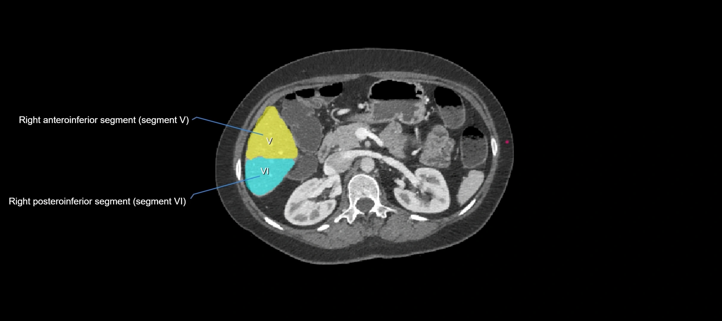 CT liver segments axial cross sectional anatomy labelled image-00028.webp